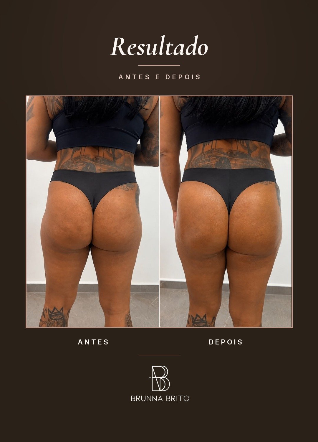 Resultado antes e depois de paciente da clínica Brunna Brito