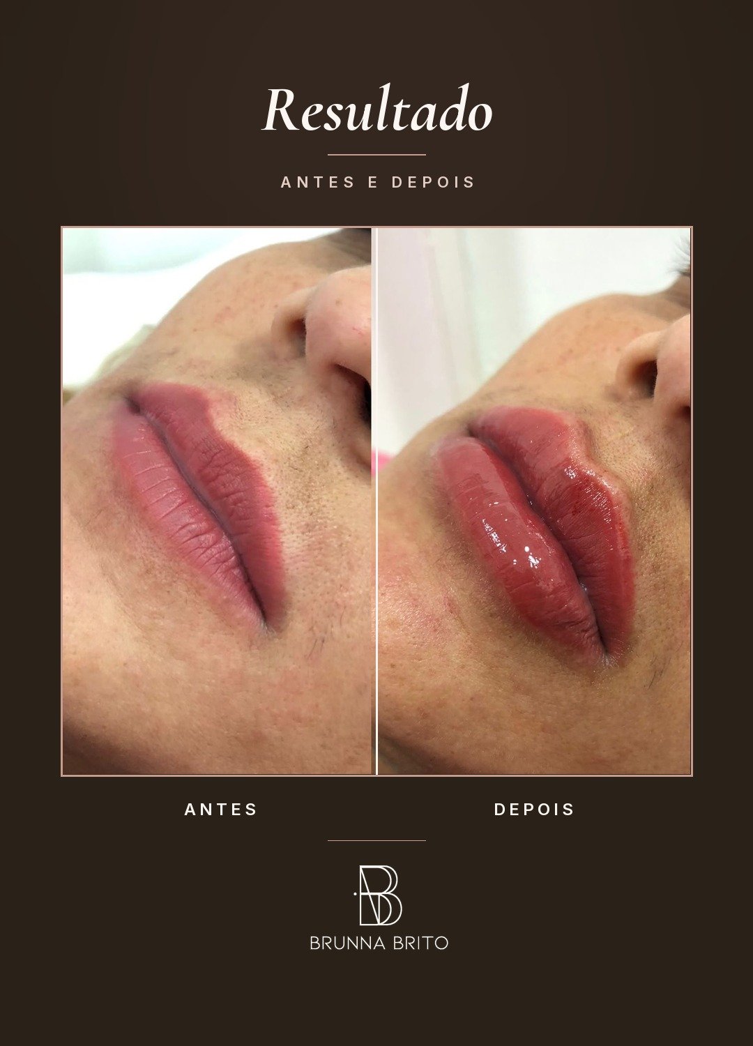 Resultado antes e depois de paciente da clínica Brunna Brito